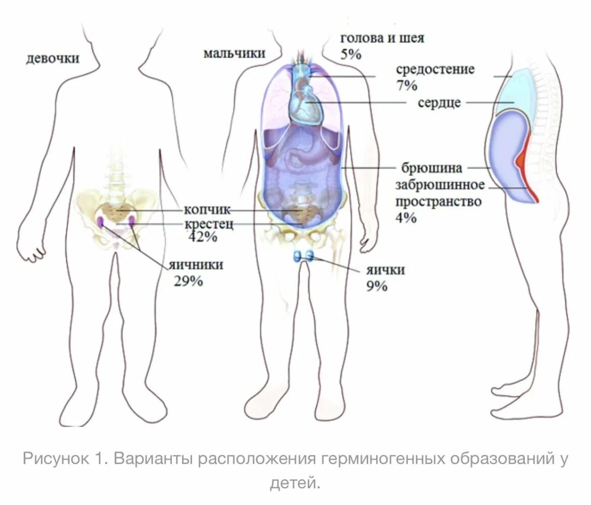 Метастазы в яичках