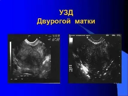 С двурогой маткой рожают