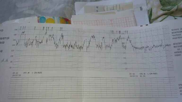 КТГ 36 недель. Шевеления плода на КТГ. На КТГ активное шевеление плода. Нормальное КТГ плода на 36 неделе.