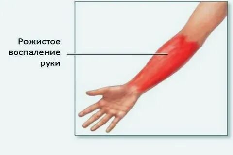 Рожа симптомы