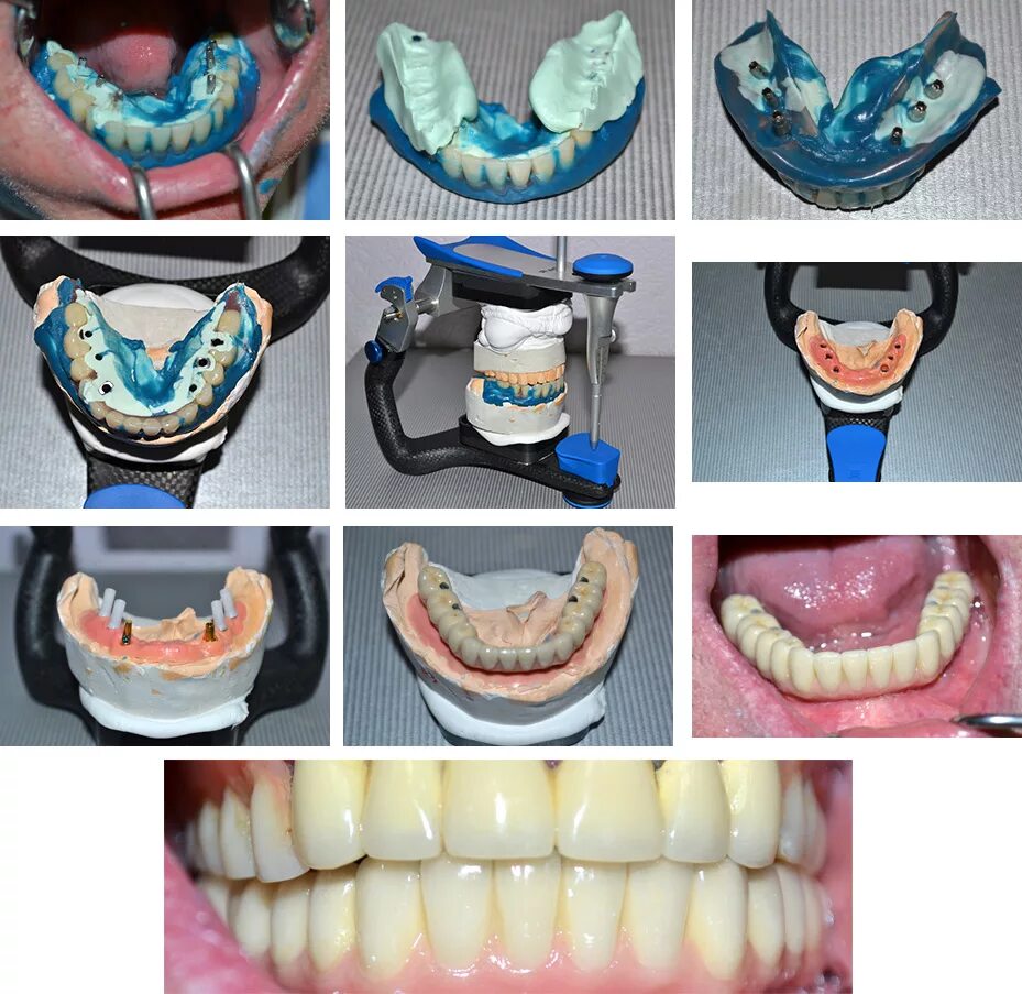 Перебазировка съемного протеза нижней челюсти. Протезирование зубов.