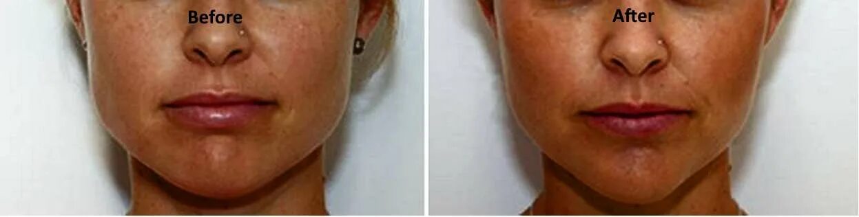 Say goodbye to the double chin! Join JoAnn Francis Medical Esthetics tomorrow. D