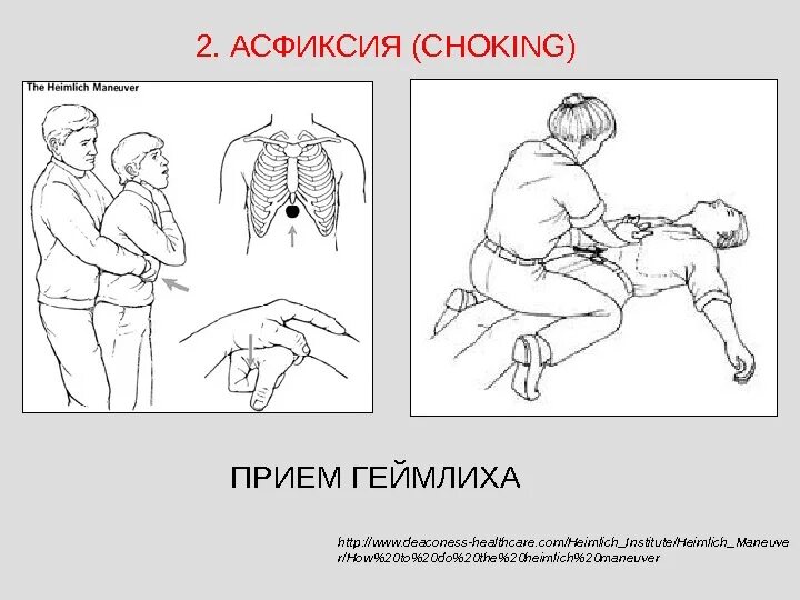 Асфиксия прием Хеймлиха. Метод Хеймлиха алгоритм. Принцип Геймлиха.