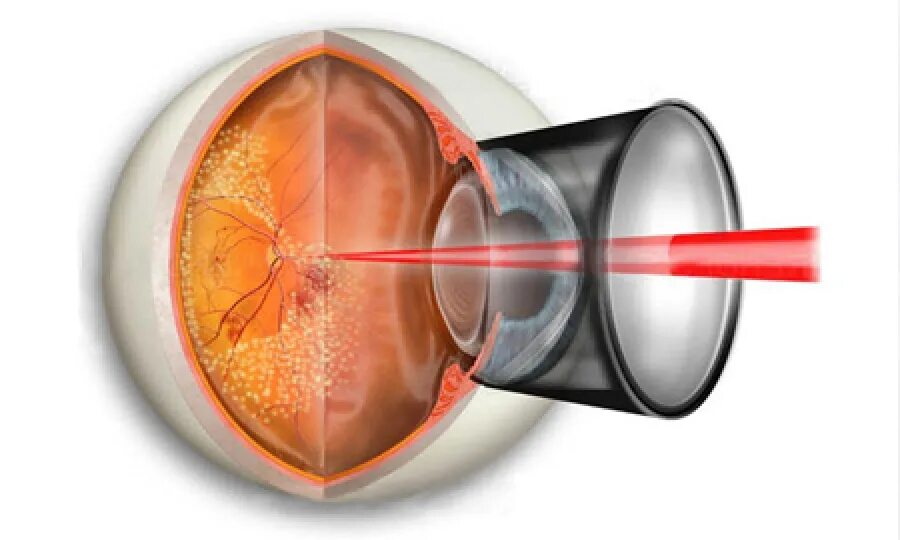 Лазерная коагуляция сетчатки. Транспупиллярная лазеркоагуляция. Ограничительная лазеркоагуляция сетчатки глаза. Периферическая лазеркоагуляция сетчатки глаза.