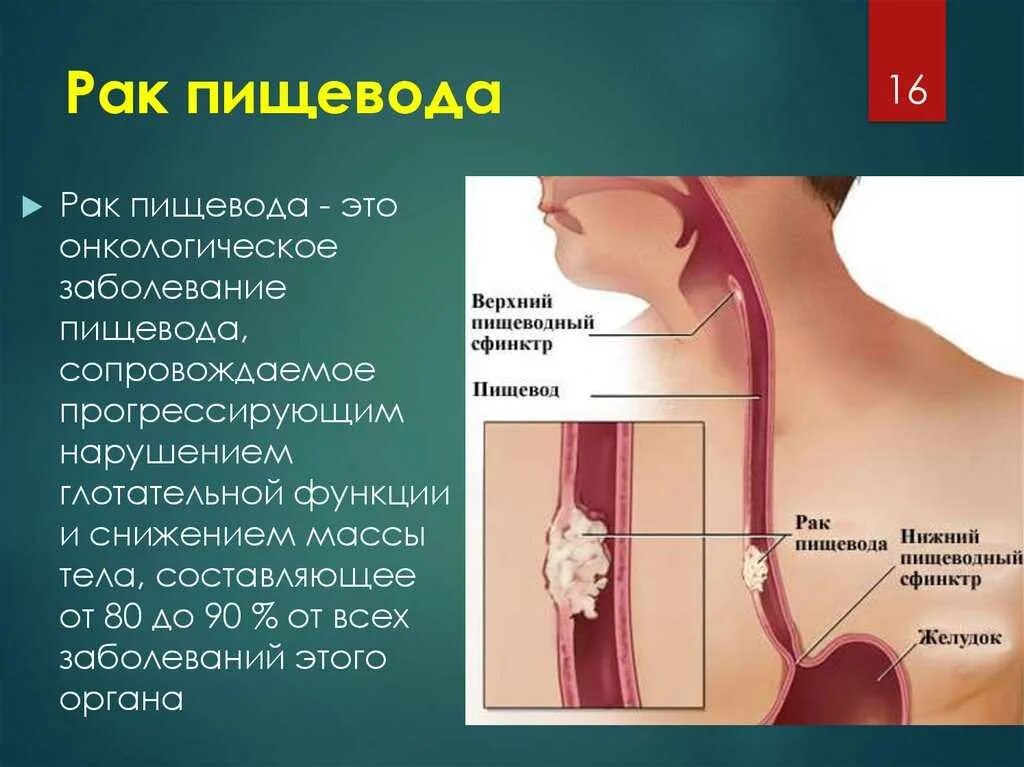 Нарушается ли пост если проглотить мокроту. Злокачественные заболевания пищевода. Опухоль средней трети пищевода. Основные симптомы заболевания пищевода.