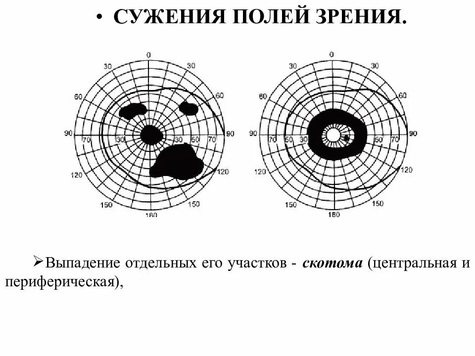 Центральная скотома периметрия. Концентрическое сужение полей зрения градусы. Поля зрения абсолютная скотома. Выпадение полей зрения периметрия.