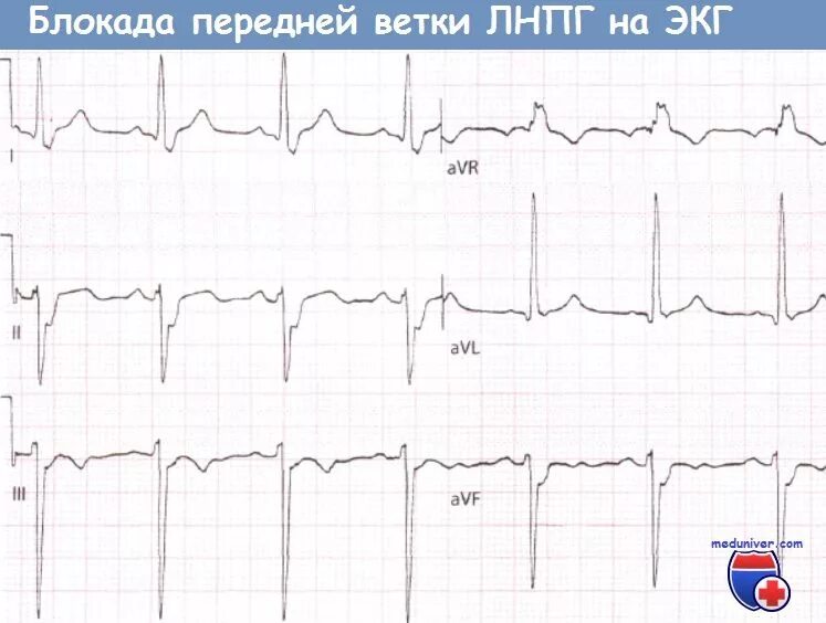 Блокада передне верхнего. Блокада левой передней ветви пучка гиса на экг. блокада передней ветви лнпг на экг. экг при блокаде передней ветви левой ножки пучка гиса. блокада левой ветви левой ножки пучка гиса.