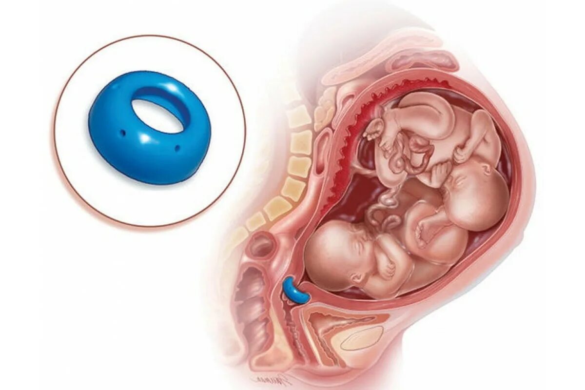 37 недель пессарий. ИЦН акушерский пессарий. Акушерское кольцо пессарий. Абортивный пессарий это. Что такое пессарий при беременности.