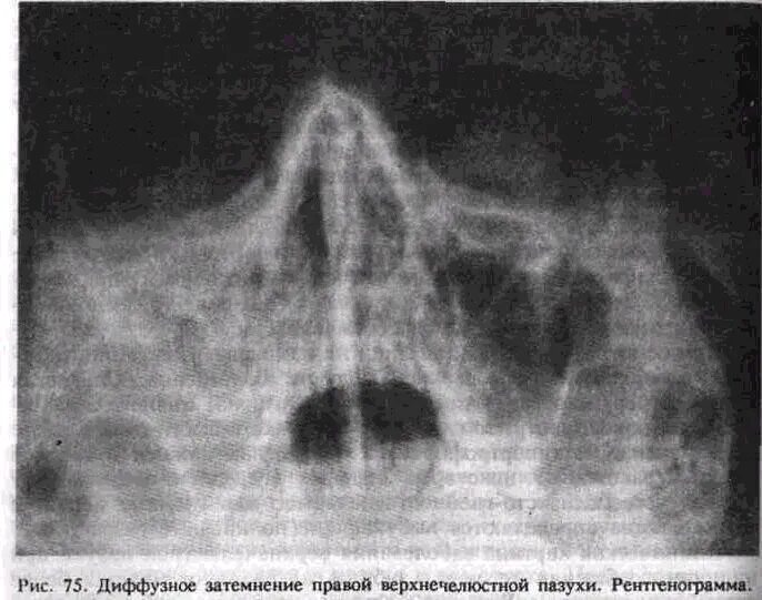 Тотальное затемнение верхнечелюстной пазухи рентген. Пристеночное затемнение гайморовых пазух рентген. Пристеночное утолщение слизистой верхнечелюстной пазухи рентген. Верхнечелюстной синусит на снимке.