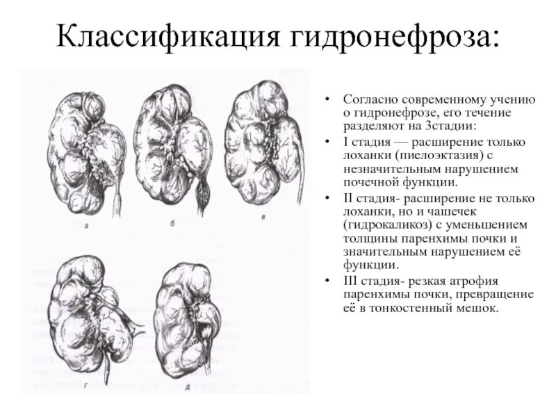 Гидронефроз классификация Лопаткина. Гидронефроз рентген признаки. Гидронефроз почки классификация. Причины расширения почек