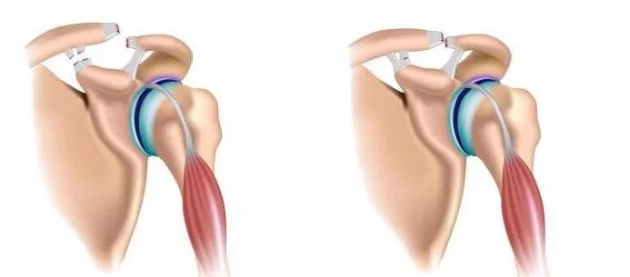Плечевые связки. Повреждение связочного аппарата плечевого сустава. Травма плечевого сустава разрыв связок. Надрыв сухожилия плечевого сустава. Растяжение связочного аппарата плечевого сустава.