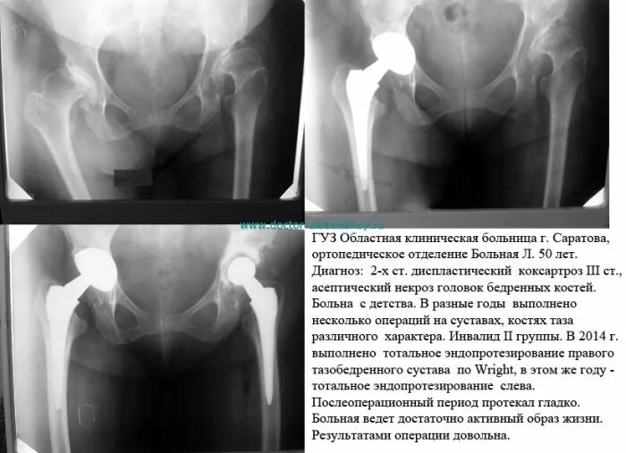 Коксартроз и асептический некроз. Асептический некроз бедренных костей. Асептический тазобедренного сустава. Асептический некроз левой тазобедренной кости. Инвалидность после эндопротезирования