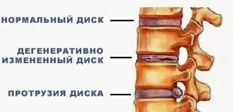 Дегенеративно-дистрофические изменения l2 l3. Диффузное выбухание межпозвоночного диска l3-l4. Денегеративные изменениягрудного отдела позвоночника. Протрузии крестцового отдела позвоночника. Начальное дегенеративные изменения шейного отдела