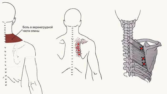 Схема боли в спине. Ромбовидная мышца спины триггерные точки. Ременная мышца шеи триггерные точки. Триггерные точки ромбовидной мышцы. Ременная мышца триггерные точки.