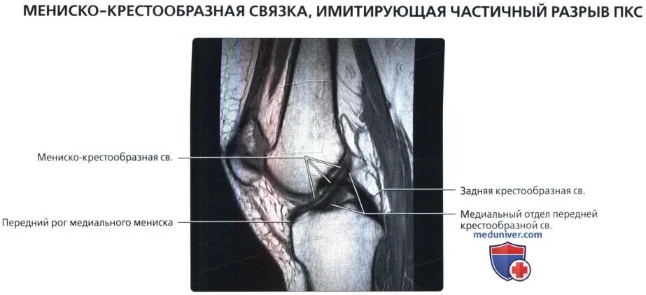 Мениско бедренная связка мрт. Менискокрестообразная связка. Задняя мениско бедренная связка мрт. Мненискобедренная свзка. Симптомы крестообразной связки коленного сустава