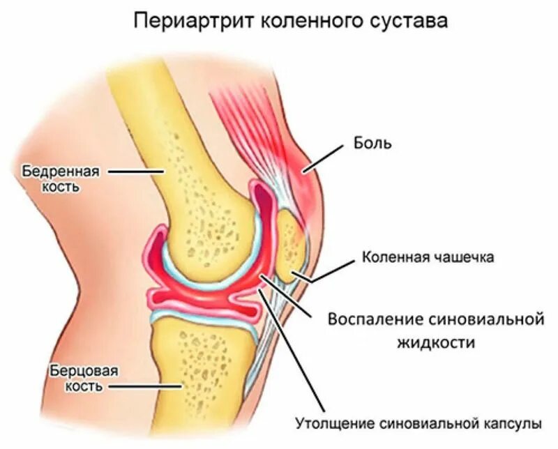 Синовит колена коленного сустава. ,Синовит синовита коленного сустава. Воспаление синовиальной оболочки коленного сустава. Периартрит коленного сустава. В правое колено долили слой