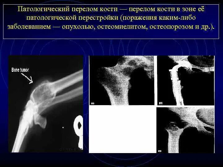 Патологический перелом бедренной кости. Патологические переломы костей. Патологические переломы костей. Псевдопаралича парро патологический перелом. Патологические переломы костей.