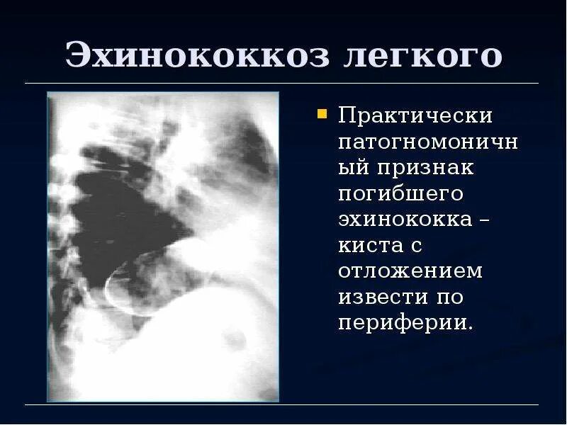 Эхинококкоз у детей симптомы. Эхинококкоз легких узи. эхинококк средостения. эхинококкоз средостения.