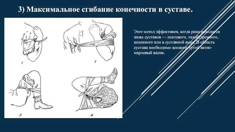 Остановка кровотечения путем сгибания конечности. Максимальное сгибание конечности. Метод максимального сгибания конечности. Максимальное сгибание конечности в суставе. Максимальное сгибание конечности в суставе при кровотечении.