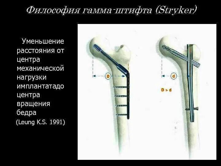 Гамма 3 2. Гамма гвоздь проксимальный бедренный. проксимальный бедренный штифт stryker. гамма штифт pfna. остеосинтез гамма штифтом.