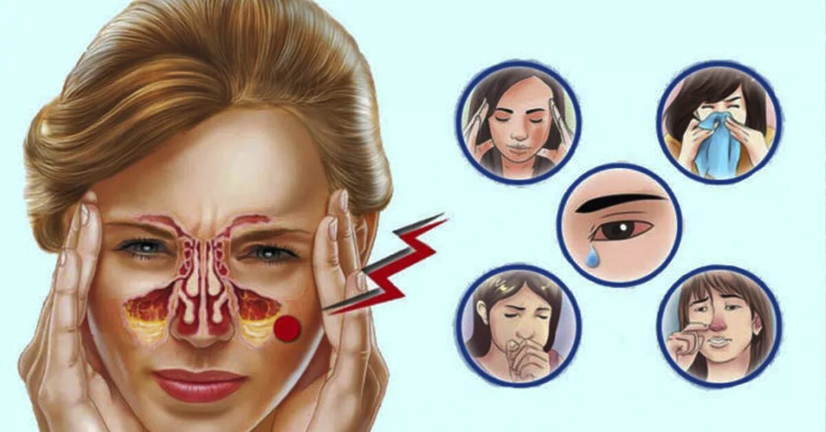 Снять отек при простуде. Симптомы аллергического ринита. Аллергический ринит симптомы.