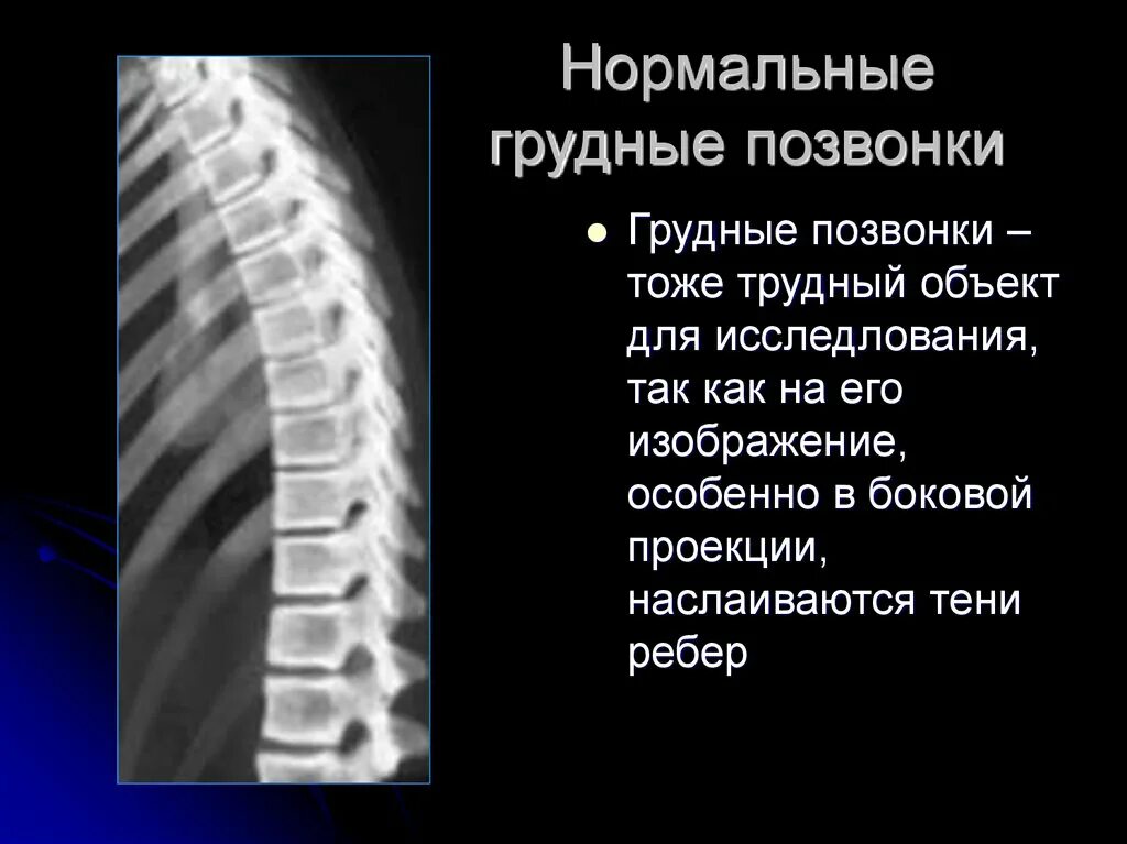 Лучевая диагностика заболеваний позвоночника. Патологии позвоночника лучевая диагностика. Грудной отдел позвоночника рентген анатомия. 10 Грудной грудной позвонок.