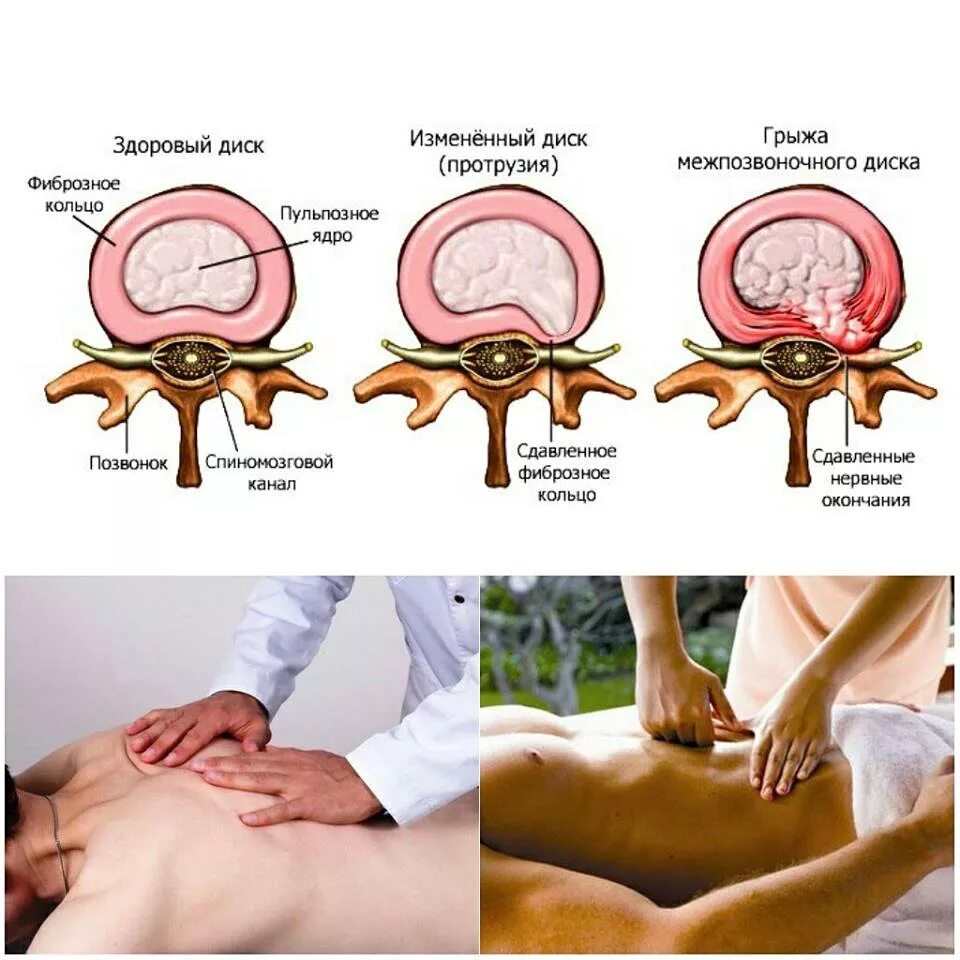 При шейной грыже можно делать массаж. Протрузия межпозвонковых дисков поясничного отдела. Массаж позвоночника грыжи диска позвоночника. Грыжа поясничного отдела протрузия диска. Массаж спины при грыже поясничного отдела и протрузиях позвоночника.