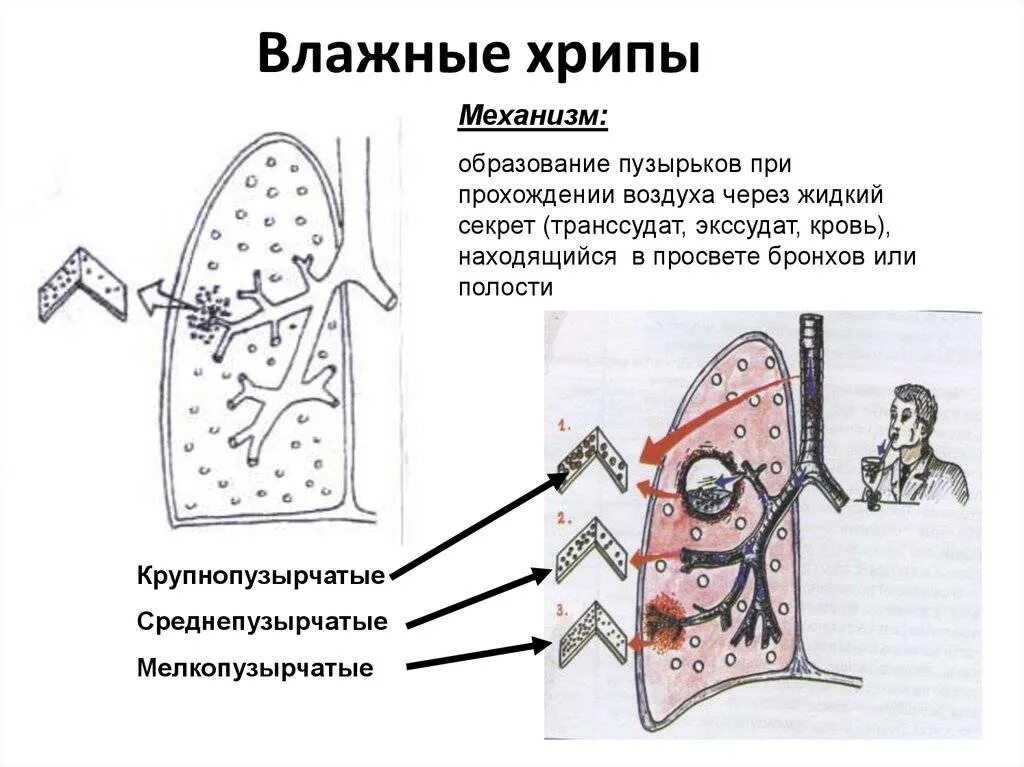 Лопающиеся пузырьки при дыхании. Механизм образования сухих хрипов схема. Механизмы образования сухих и влажных хрипов схема. Механизм образования мелкопузырчатых хрипов. Схема возникновения хрипов.