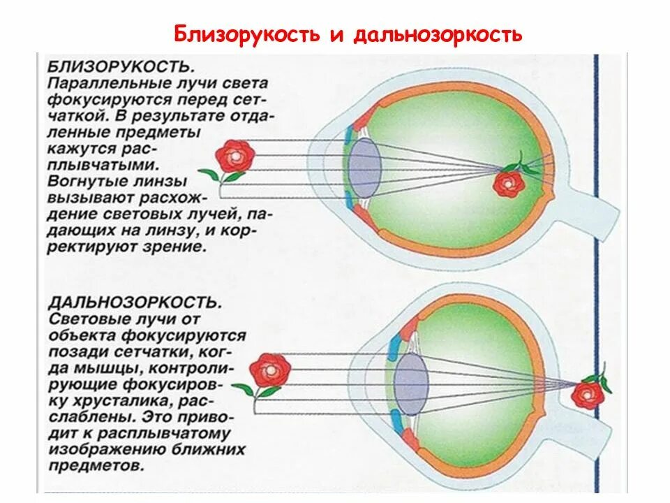 Точка лежащая зрение. При дальнозоркости световые лучи фокусируются. Строение глаза близорукость и дальнозоркость. Зрительный анализатор дальнозоркость и близорукость. Зрение человека дальнозоркость и близорукость.