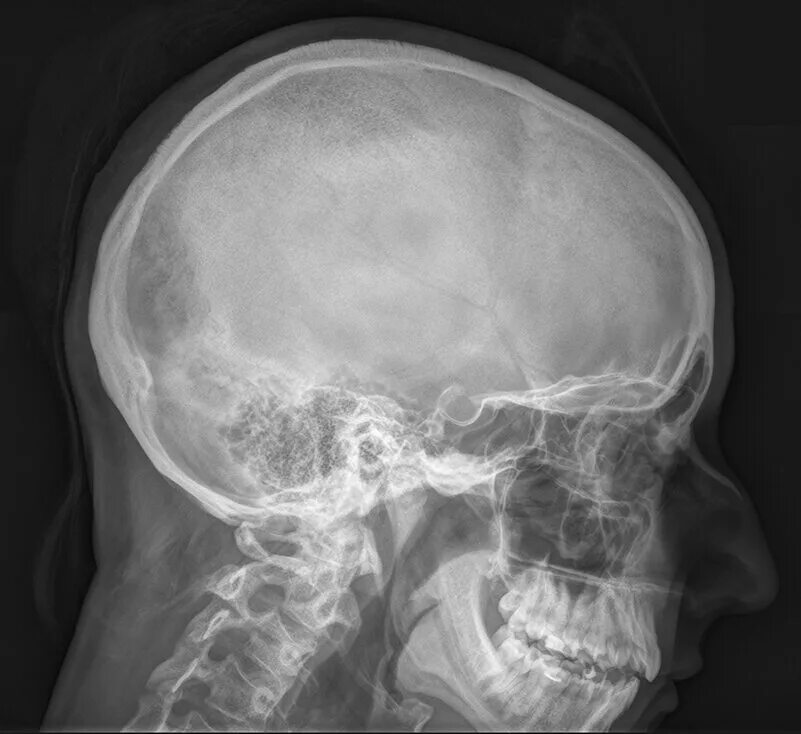 Турецкие седло кость. Рентгенография черепа турецкое седло. Турецкое седло на ТРГ. Рентген снимок черепа - турецкое седло. Рентген костей черепа и турецкого седла.