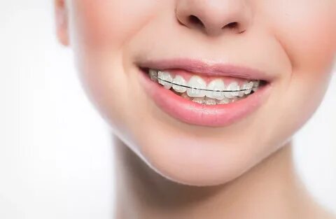 Type of brackets