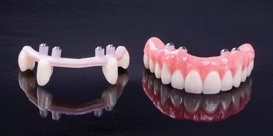 протез на присосках на верхнюю. верхний съемный зубной протез. протез на присосках на верхнюю. протез верхней челюсти. бюгельный протез задних зубов.