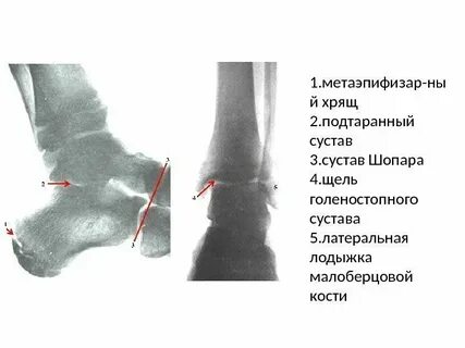 Подтаранный сустав