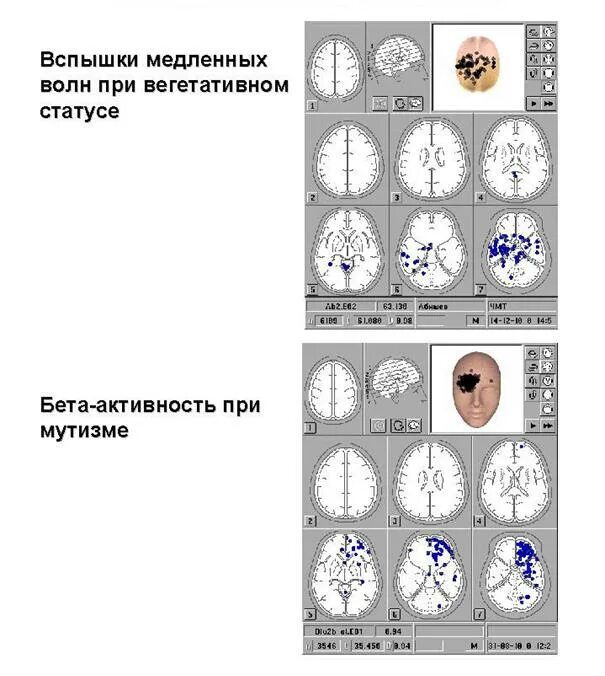 Ээг асимметрия. Электроэнцефалография чмт. ээг после чмт. ээг при когнитивных расстройствах. ээг головного мозга при когнитивных нарушениях.