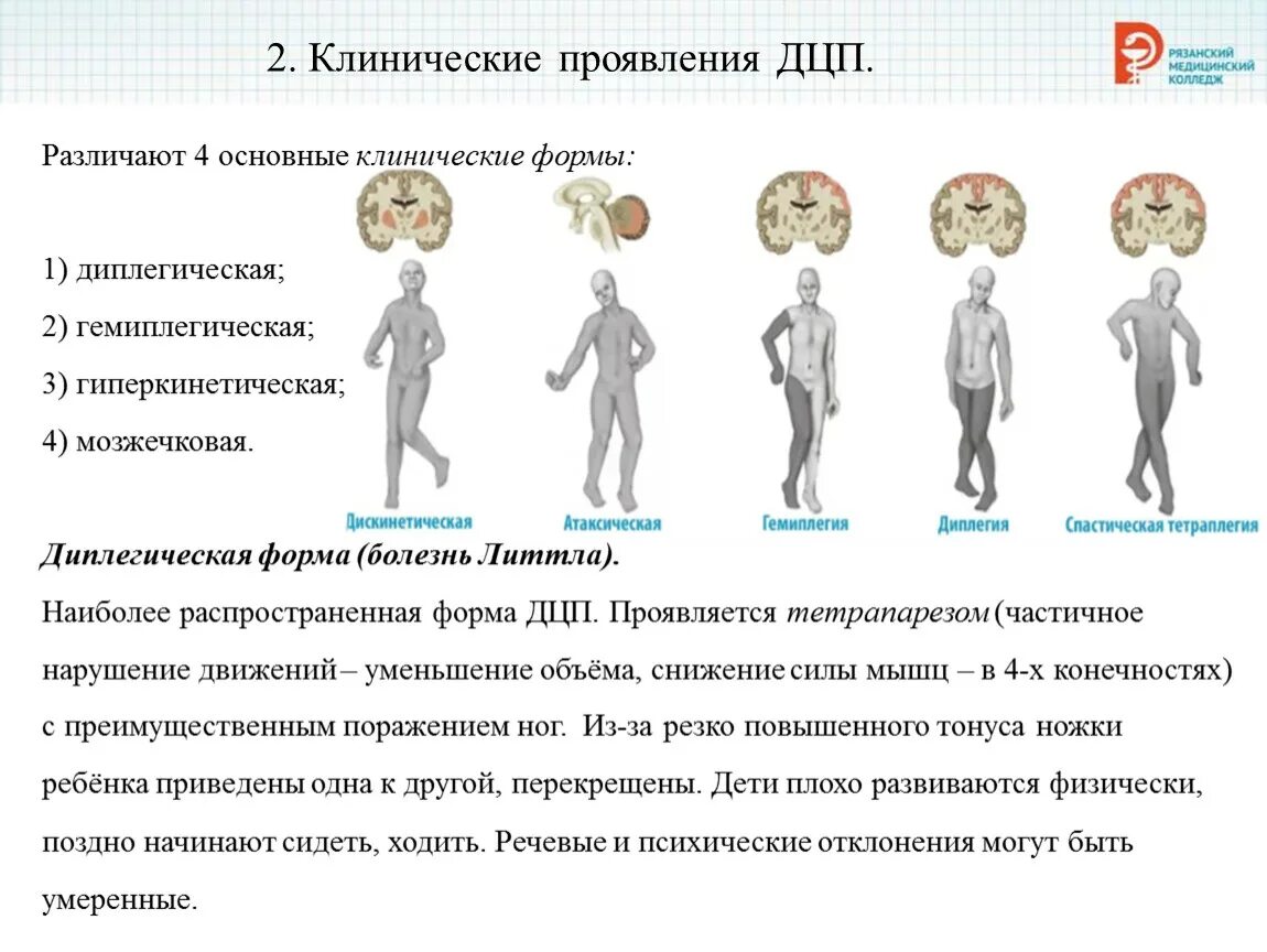 Гиперкинетическая форма при ДЦП. Гиперкинетическая форма ДЦП симптомы. 4 Основные формы ДЦП. Дети с гиперкинетической формой ДЦП. Последствия дцп