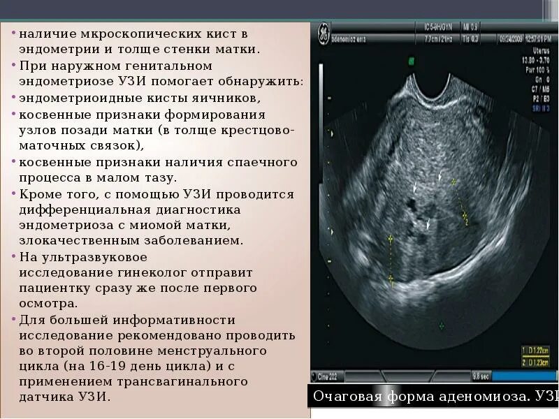 При аденомиозе можно забеременеть. Эндометриоз яичников на УЗИ. Эндометриома УЗИ картина. Эндометриоидная киста яичника на УЗИ. Эндометриоидные кисты яичников УЗИ.