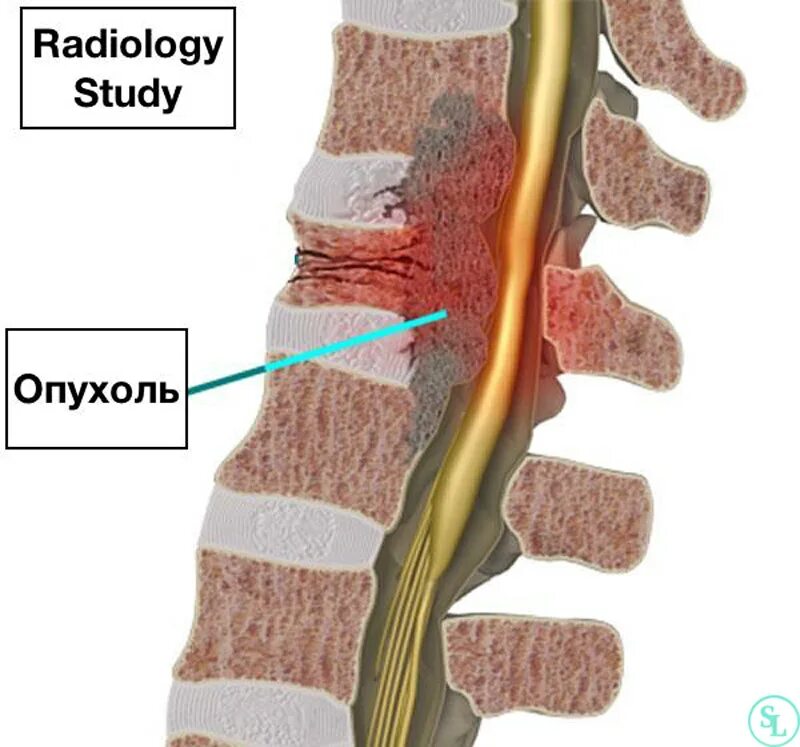 Позвоночник припухлость
