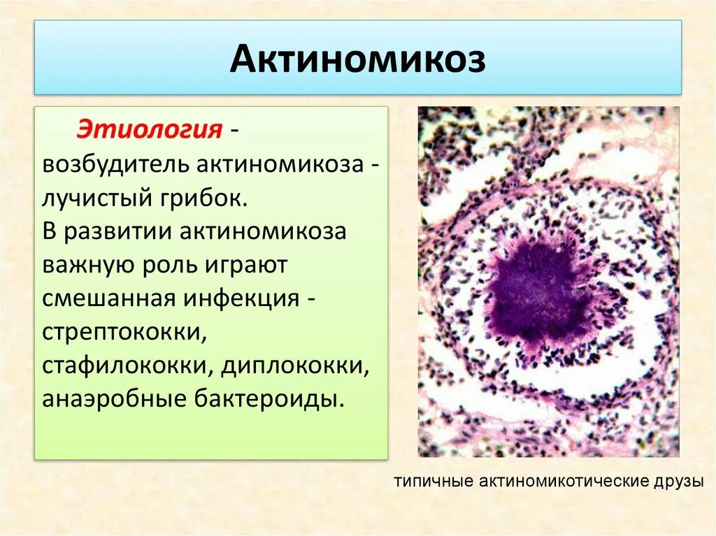 Актиномикоз это. Этиология актиномикоза челюстно-лицевой области. актиномицеты возбудители болезней.
