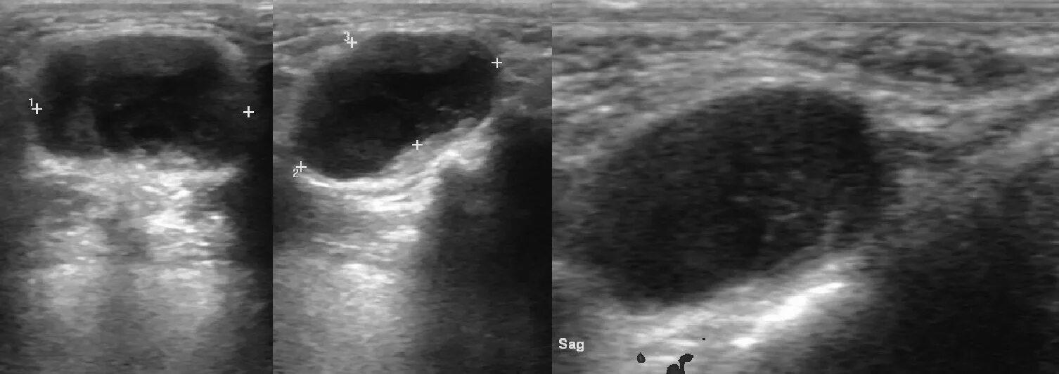 Гиперплазия лимфоузлов у детей. Киста щитовидной железы на УЗИ. Бранхиогенная киста шеи УЗИ. Гипоплазия щитовидной железы УЗИ. Срединная киста шеи на УЗИ.