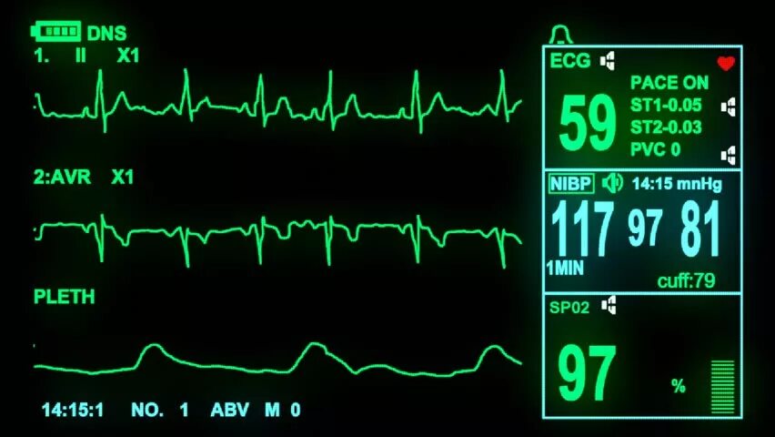 Мониторинг операций. Экран ЭКГ. Кардиограмма на мониторе. Экран с пульсом в больнице. Прибор показывающий кардиограмму.