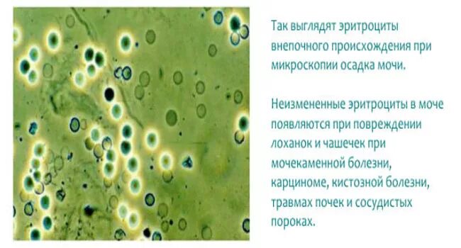 Почему повышенный эритроциты в моче. Свежие неизмененные эритроциты в моче это. Измененные и неизмененные эритроциты в микроскопии мочи. Микроскопия осадка мочи эритроциты измененные. Измененные и неизмененные эритроциты в моче микроскопия.