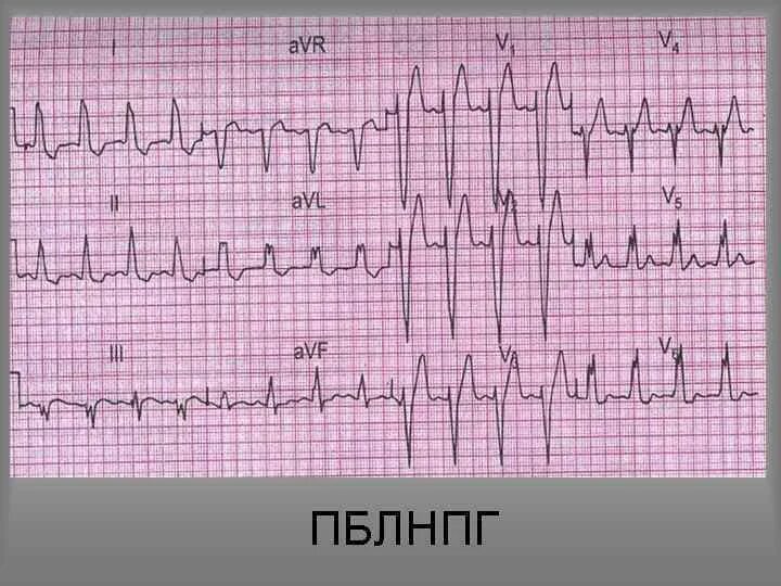 Блокада левой ножки пучка гиса на экг