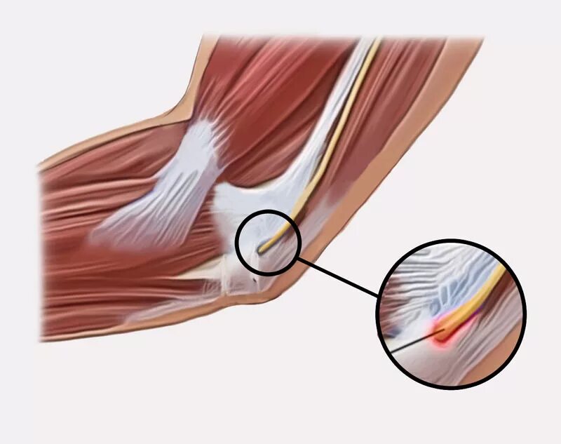 Сколько заживает сухожилие. Синдром кубитального канала локтевого. Эпикондилит локтевого нерва. Туннельный синдром локтевого сустава. Кубитальный туннельный синдром.
