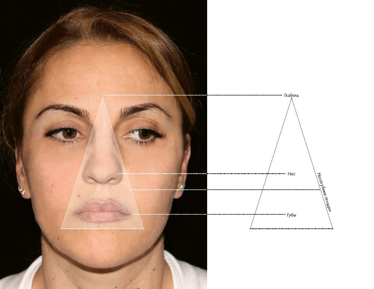 Прыщи в треугольнике смерти. Треугольник смерти на лице. Треугольник смероии на лице. Носогубный треугольник.