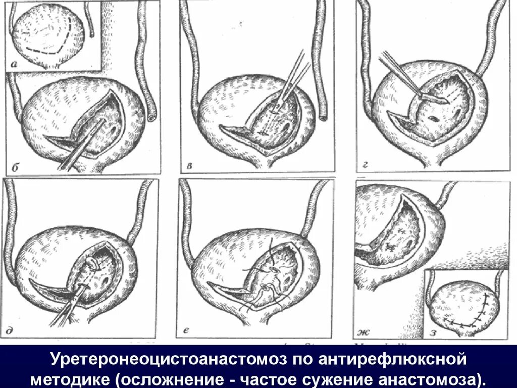 Реимплантация мочеточника по коэну. Уретероцистоанастомоз этапы операции. Реимплантация мочеточника. Лапароскопическая уретероцистонеостомия. Неоимплантация мочеточника по коэну.