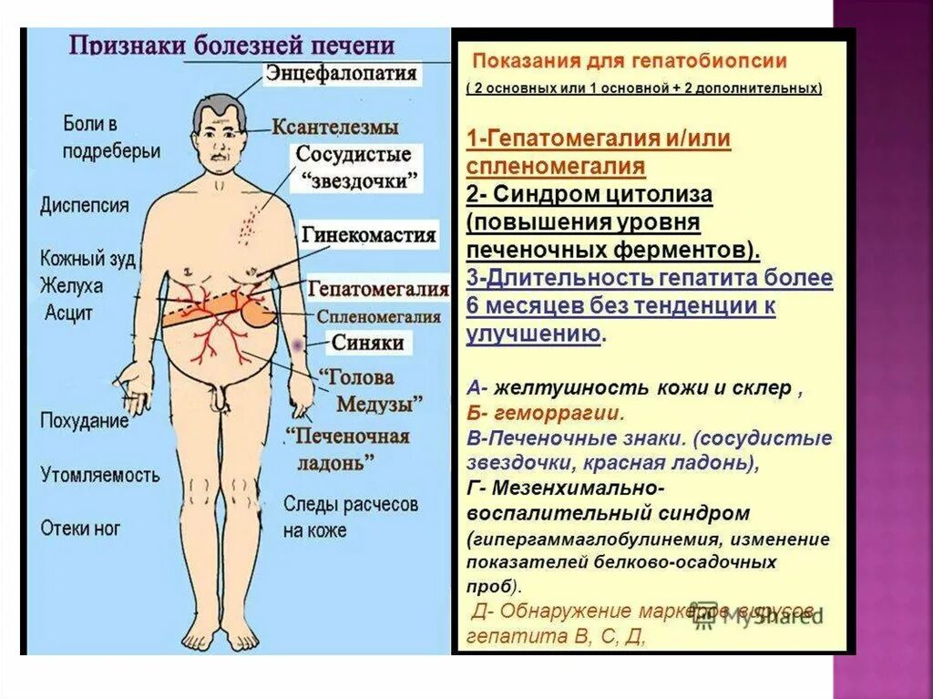 Симптомы поражения печени. Симптомы церозапечент. Нарушение печени симптомы.