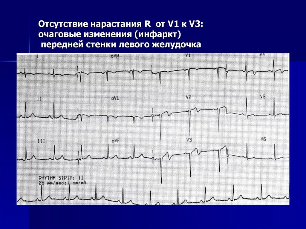 Очаговые изменения желудочка