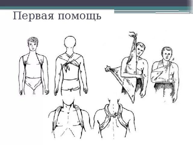 Оказание помощи при переломе ключицы. Иммобилизация при переломе ключицы повязка. перевязка при переломе ключицы. иммобилизация при переломах косынка. перелом ключицы иммобилизация.