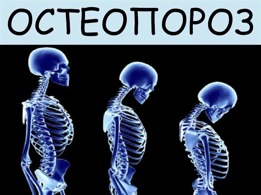 Системное заболевание скелета