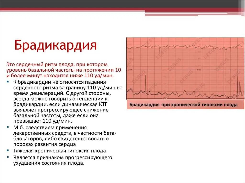 Замедление сердечных сокращений